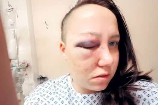 Cora Mitchard is partially blind after Nathan Cook kicked a can after he was tasered by a security guard at the Port Arms, Deal