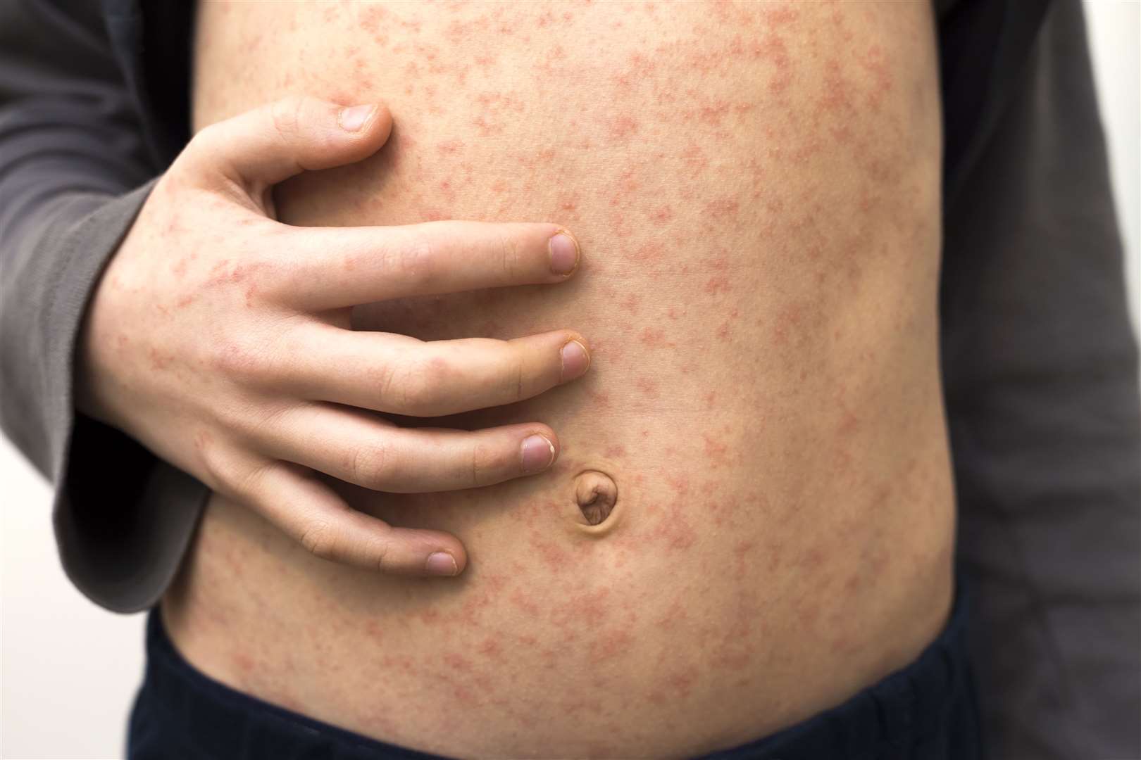 There are fears low uptake of MMR will lead to measles outbreaks. Image: Stock photo.