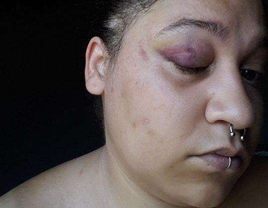 Mrs Bruce was left severely bruised after the attack with a black eye (3314100)