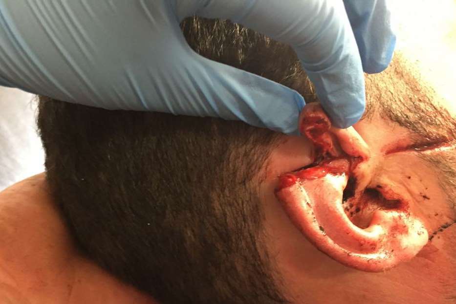 Matthew White's injury to his ear after the attack