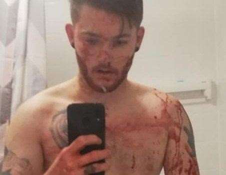 He was left covered in blood following the assault